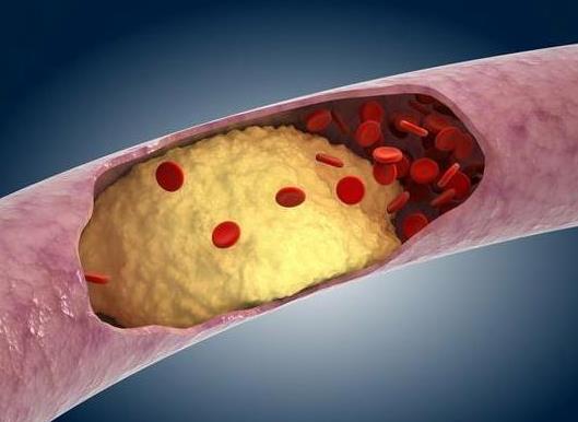 輕癥急性胰腺炎會有后遺癥嗎?重癥急性胰腺炎有救嗎