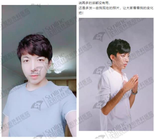 沈陽杏林整形外科醫(yī)院:下頜后縮怎么辦
