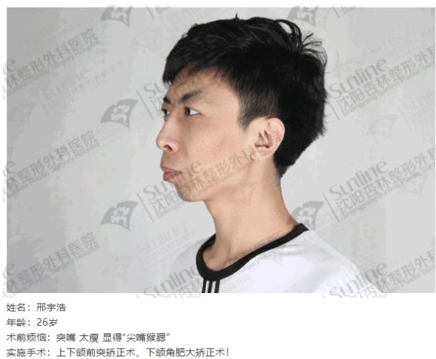 沈陽杏林整形外科醫(yī)院:下頜后縮怎么辦
