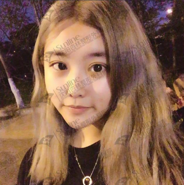 沈陽雙眼皮前后對(duì)比,雙眼皮真人實(shí)拍案例