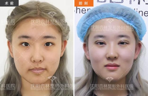 沈陽雙眼皮前后對(duì)比,雙眼皮真人實(shí)拍案例