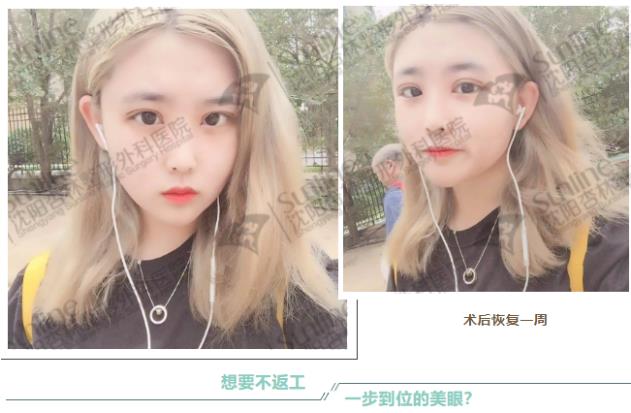 沈陽雙眼皮前后對(duì)比,雙眼皮真人實(shí)拍案例