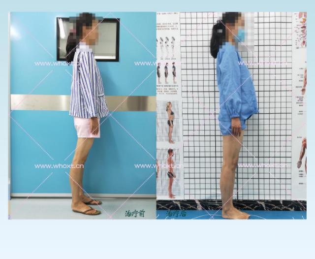 綁腿可以矯正O型腿嗎?武漢中陽醫(yī)院四維矯形技術七天矯正腿型異常