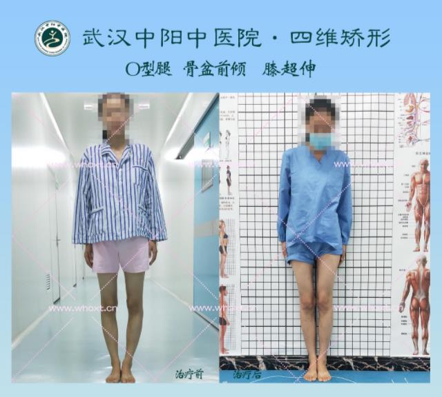 綁腿可以矯正O型腿嗎?武漢中陽醫(yī)院四維矯形技術七天矯正腿型異常