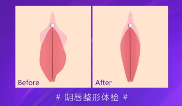 小陰唇切除手術成都