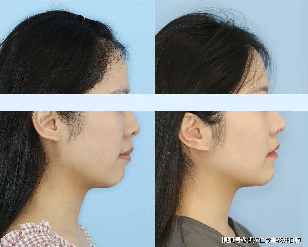 被嘴突影響的顏值,該如何拯救?