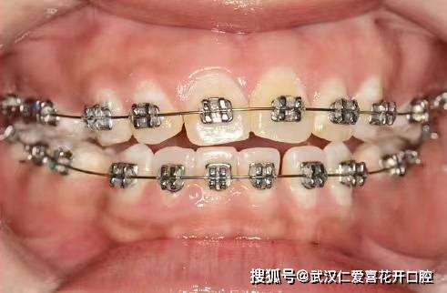被嘴突影響的顏值,該如何拯救?