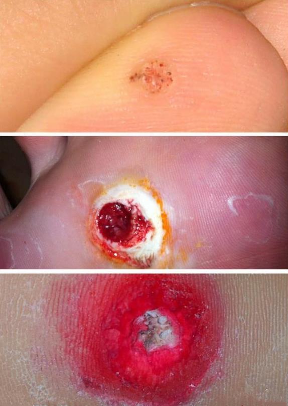 為什么長雞眼會傳染嗎 腳上的雞眼位置圖片怎么根治
