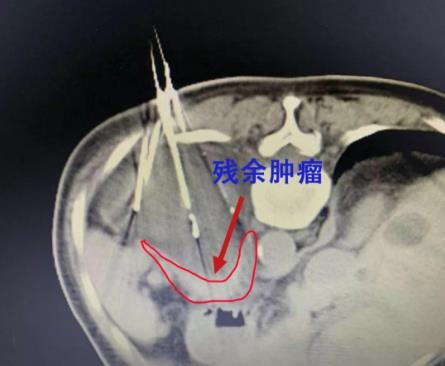 廣州復(fù)大腫瘤醫(yī)院評(píng)價(jià)好嗎 診療服務(wù)評(píng)價(jià)有保障