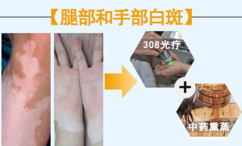華研白癜風(fēng)醫(yī)院的308激光治療效果怎么樣?前端技術(shù),值得相信