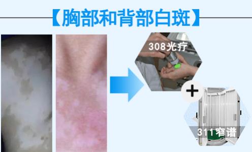 華研白癜風(fēng)醫(yī)院的308激光治療效果怎么樣?前端技術(shù),值得相信