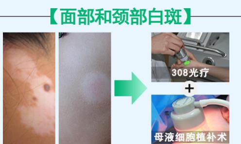 華研白癜風(fēng)醫(yī)院的308激光治療效果怎么樣?前端技術(shù),值得相信