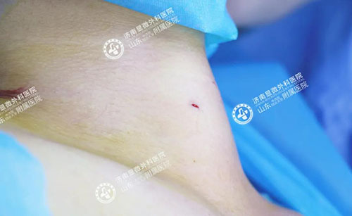 濟南顯微外科醫(yī)院治療甲狀腺怎么樣?微創(chuàng)治療專業(yè)醫(yī)院 11-5-6-500.jpg