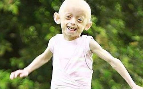 世界上最老的孩子 塞斯·庫克12歲的年紀(jì)90歲的面容