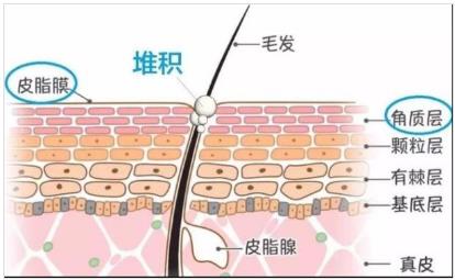 北京伊美爾幸福醫(yī)院:閉口粉刺會自己慢慢消失嗎?