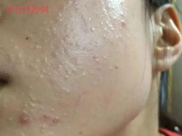 北京伊美爾幸福醫(yī)院:閉口粉刺會自己慢慢消失嗎?