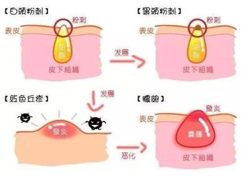 北京伊美爾幸福醫(yī)院:閉口粉刺會自己慢慢消失嗎?