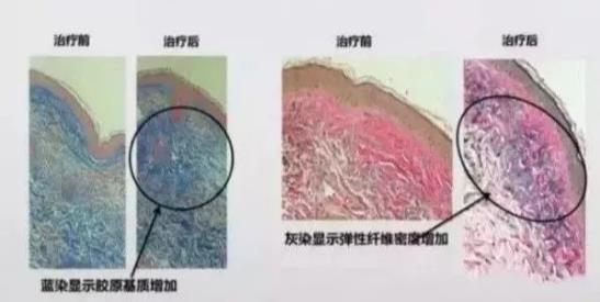 激光祛斑會不會損害皮膚?北京伊美爾健翔醫(yī)院