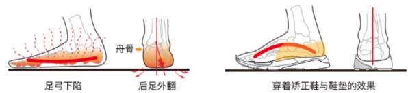干預(yù)嚴(yán)重扁平足,科學(xué)穿著矯正鞋進(jìn)行