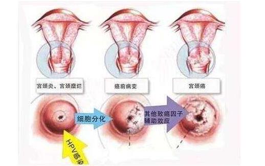 宮頸活檢費(fèi)用是多少 宮頸活檢的注意事項(xiàng)