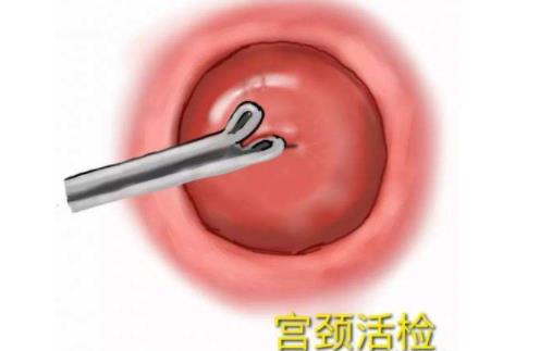 宮頸活檢費(fèi)用是多少 宮頸活檢的注意事項(xiàng)