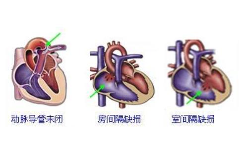 先天性心臟病能懷孕嗎 先天性心臟病遺傳嗎