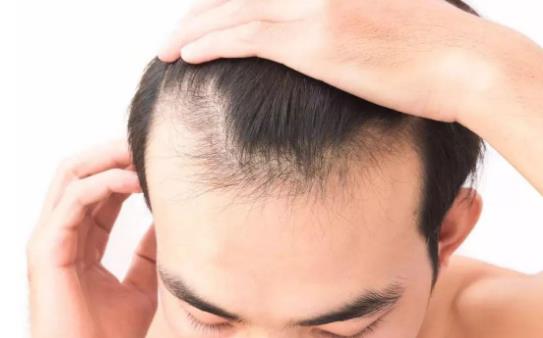 男人脫發(fā)怎么辦?男人脫發(fā)是什么原因引起的