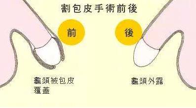 男人為什么要割包皮?割包皮前要注意事項 割包皮后注意事項