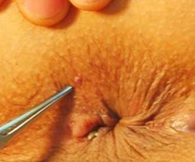 女性痔瘡的圖片,痔瘡的臨床表現(xiàn)、檢查、診斷及手術(shù)治療