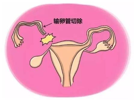 宮外孕是怎么引起的?如何有效預(yù)防宮外孕