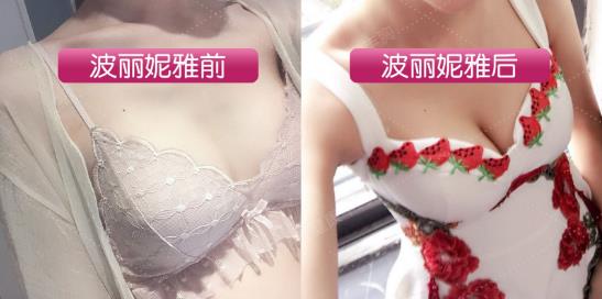 怎么讓胸自然變大?什么方法豐胸最安全有效不反彈