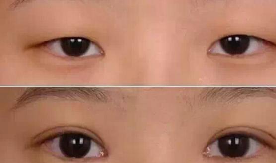 割雙眼皮哪個季節(jié)適合 什么時候割雙眼皮最好