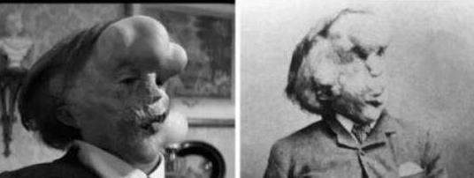 五、肢體肥大的Joseph Merrick.jpg