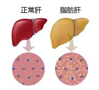 十大男性高發(fā)疾病排行榜,肺癌和吸煙有關(guān)、肝癌愛找上男人