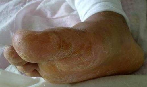 腳氣是身體在排毒嗎 腳氣會(huì)通過鞋子傳染嗎