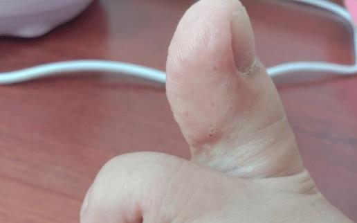 腳氣是身體在排毒嗎 腳氣會(huì)通過鞋子傳染嗎
