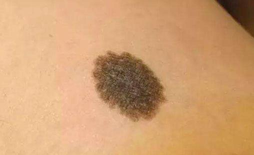 惡性黑色素瘤圖片 黑色素瘤最后有多痛苦