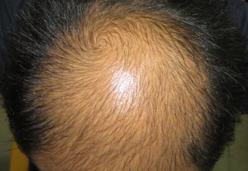 所謂“養(yǎng)腎補(bǔ)腎”防脫發(fā)，風(fēng)牛馬不相及