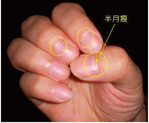 指甲上的半月痕你懂多少？指甲半月痕與健康吉兇