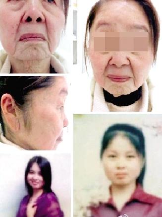 85年少婦分娩后變老太，獲得性面部皮膚衰老癥怪病無藥可醫(yī)，早婚早育生第二胎