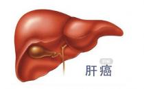  如何預(yù)防肝癌 ？