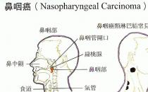 鼻咽癌的早期癥狀有哪些？