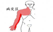  什么是胸廓出口綜合征？