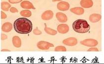 什么是骨髓增生異常綜合征？