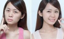 自體脂肪墊下巴術(shù)后如何護理?