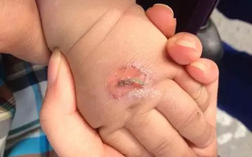 孩子常見(jiàn)的意外損傷類型有哪些？