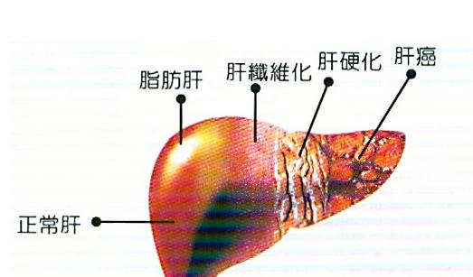 脂肪肝的治療方法 應(yīng)酬男應(yīng)該看看