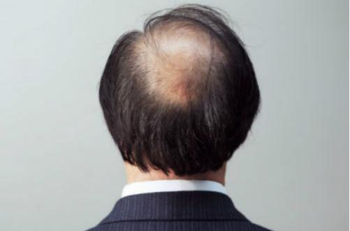 想要遠(yuǎn)離脫發(fā) 男人要做持久戰(zhàn)