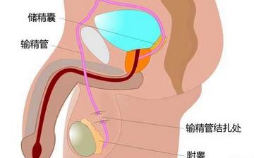 【男性結(jié)扎】男性結(jié)扎手術(shù)_結(jié)扎手術(shù)對男性的影響_男性結(jié)扎注意什么 【男性結(jié)扎】男性結(jié)扎手術(shù)_結(jié)扎手術(shù)對男性的影響_男性結(jié)扎注意什么
