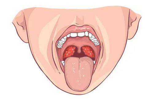 扁桃體發(fā)炎吃什么湯 食療效果好